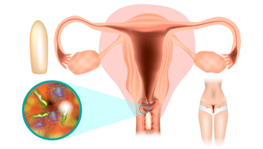 7 sai lầm chị em cần tránh khi sử dụng thuốc đặt phụ khoa